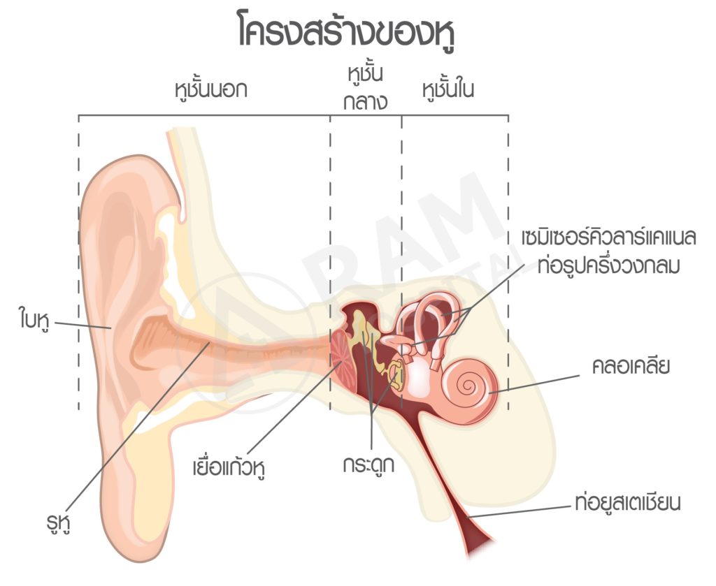 โรคหินปูนในหูเคลื่อน