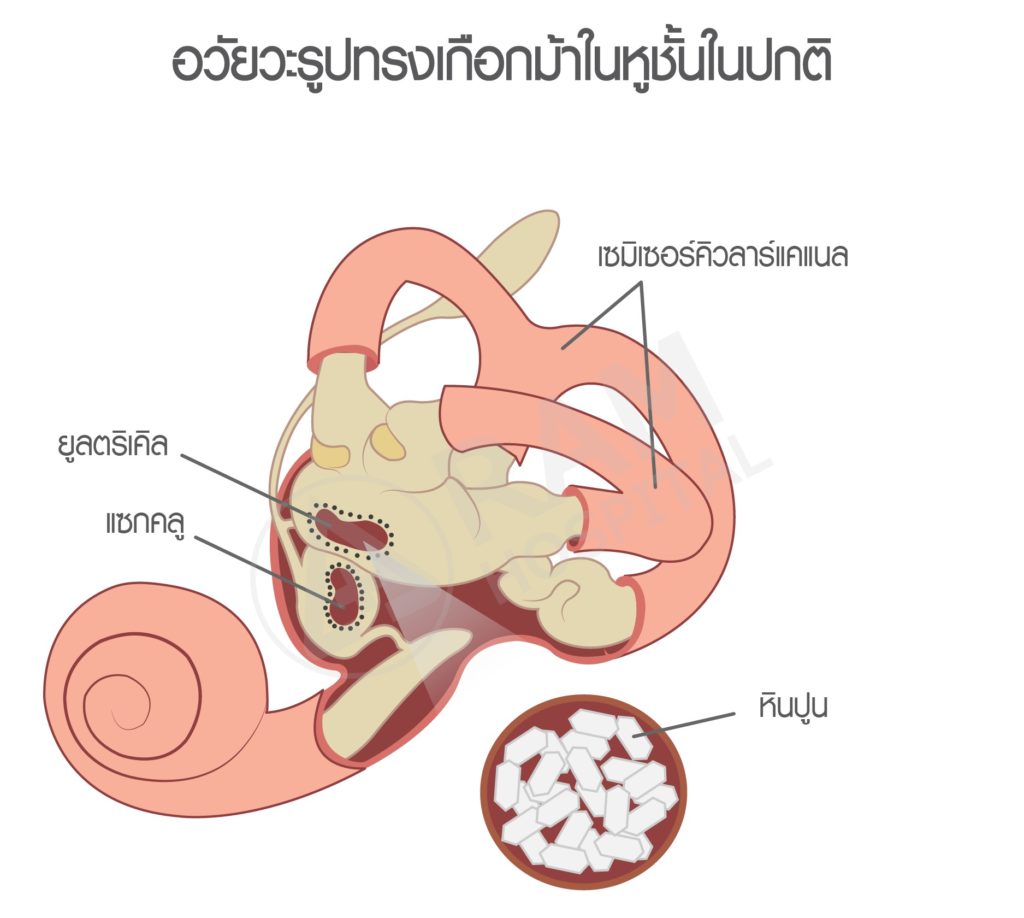 โรคหินปูนในหูเคลื่อน