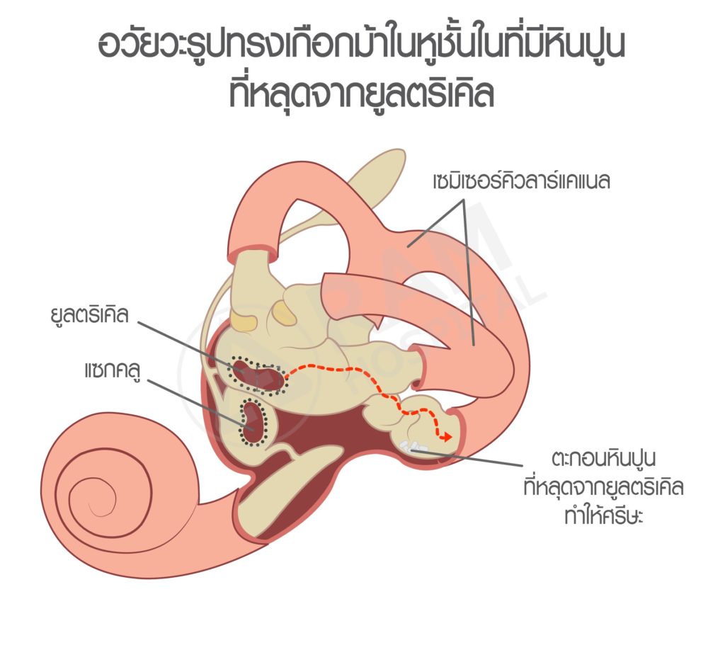 โรคหินปูนในหูเคลื่อน