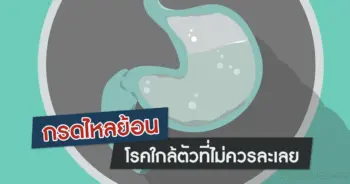 กรดไหลย้อน