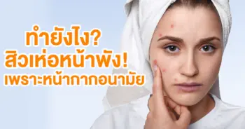 สิว