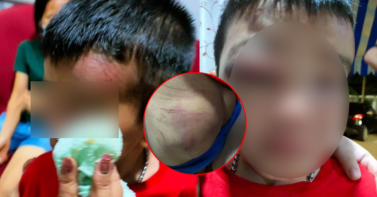 พ่อเลี้ยงโหดทุบตี 6ขวบ(หน้าปูด-ตาปิด)