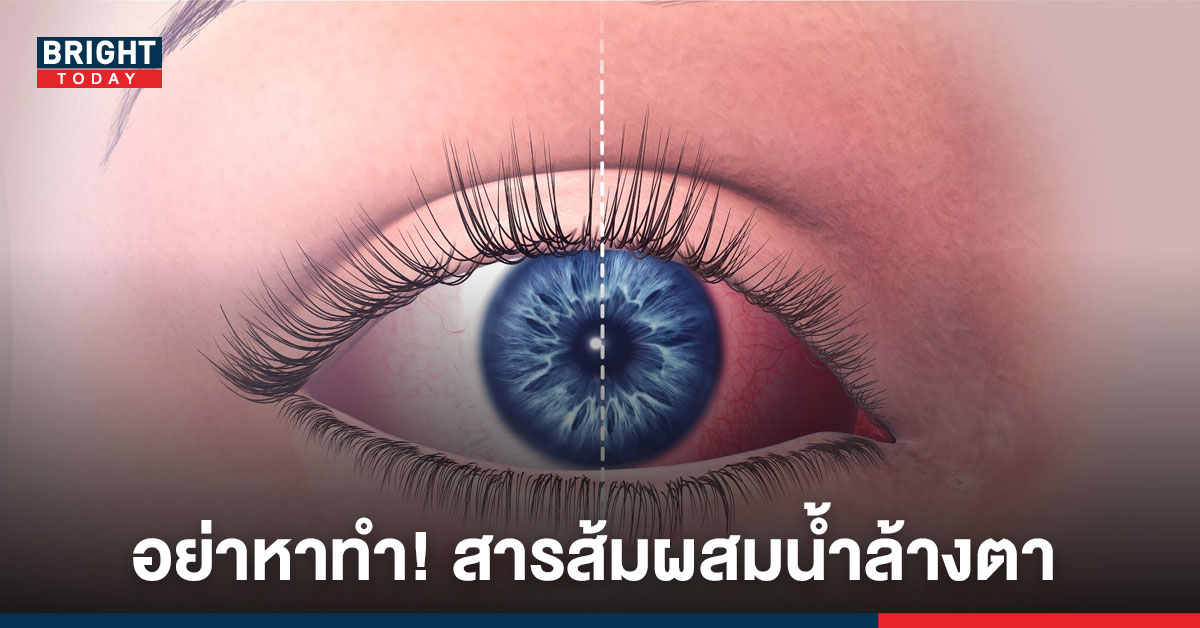 โรคตาแดง แฝงมากับหน้าฝน เตือน อย่าหาทำ