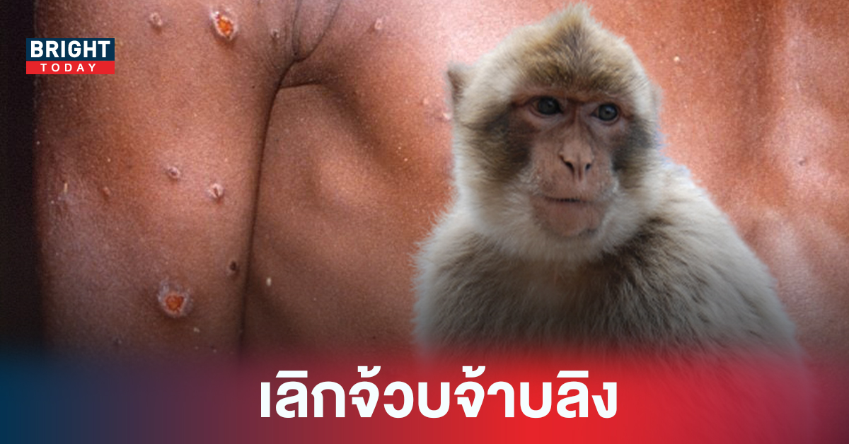 โฆษกองค์การอนามัยโลก จ่อเปลื่ยนชื่อ โรคฝีดาษลิง หวั่นทำให้ลิงเป็นผู้มีมลทินมัวหมอง
