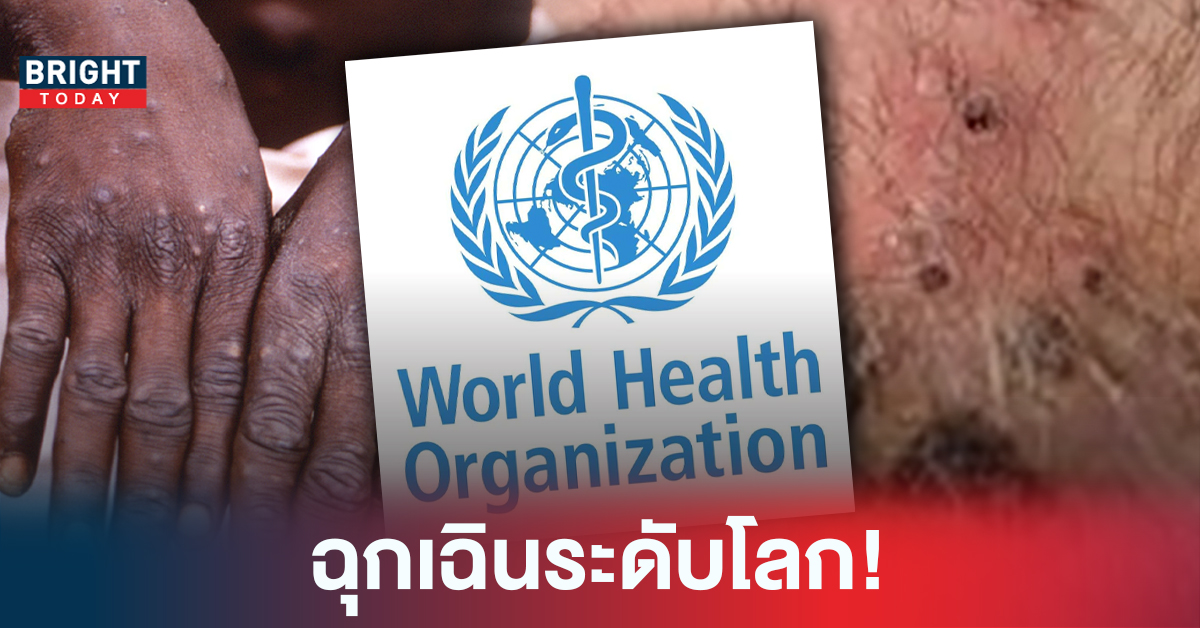 WHO ประกาศให้ “โรคฝีดาษลิง” เป็นภาวะฉุกเฉินด้านสาธารณสุขของโลก