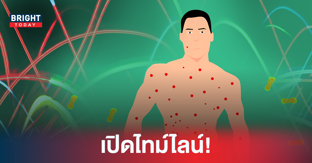 เปิดไทม์ไลน์ ผู้ป่วย “ฝีดาษลิง” รายแรกในไทย