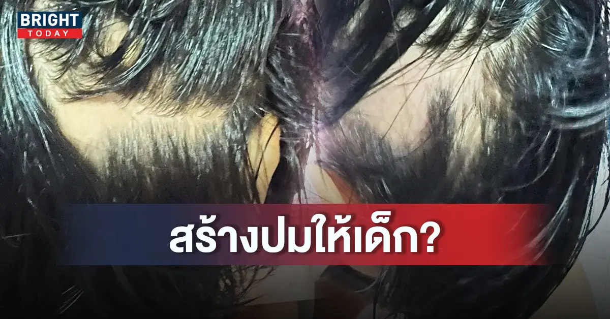 -9-ขวบผมร่วง