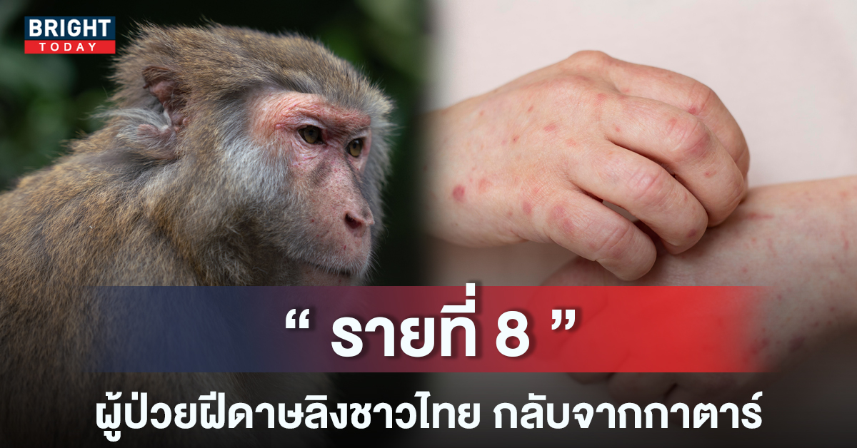 ติดเพิ่ม! ผู้ป่วยฝีดาษลิง รายที่ 8 พบเป็นชาวไทย เดินทางกลับมาจากกาตาร์