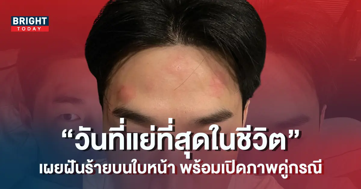 เฮนรี่-เผยฝันร้ายบนใบหน้า-พร้อมเปิดภาพคู่กรณี-4