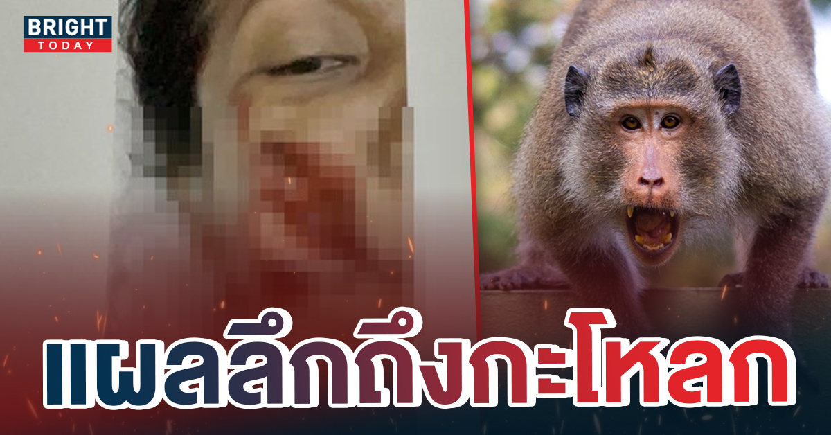 ร้องทุกข์! พนักงานสวนสัตว์ ถูกลิงป่ากัด ผู้บริหารไม่ช่วยเหลือ สูญเงินรักษาเองกว่า 9 หมื่น
