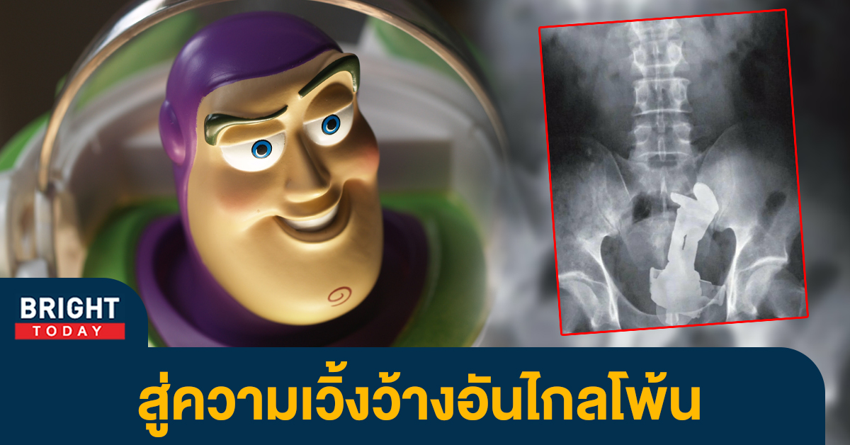 เจอแบบนี้เป็นงง ตุ๊กตา Buzz Lightyear จาก Toy Story อยู่ในทวารหนักของผู้ป่วย