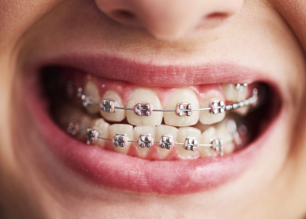 shot-child-s-teeth-with-braces