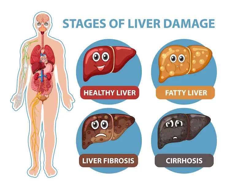 diagram-showing-stages-liver-dam
