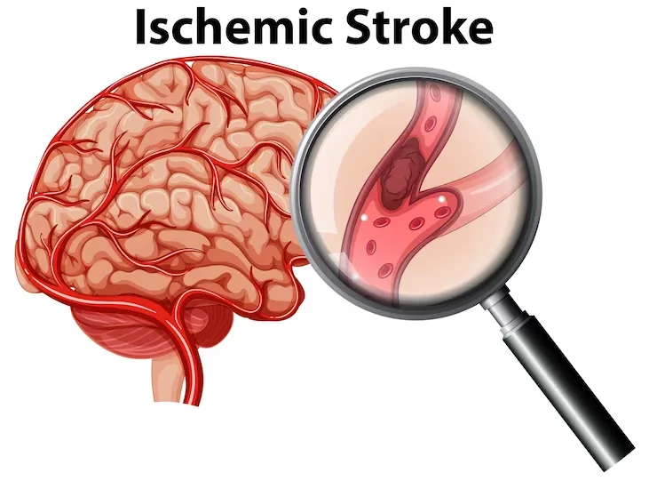 magnified-ischemic-stroke-concep