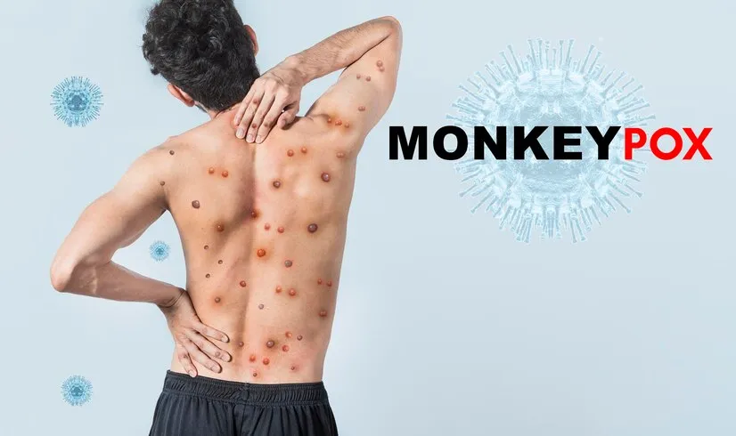 people-with-monkeypox-isolated-b