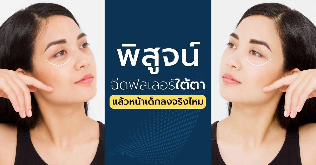 ฉีดฟิลเลอร์ใต้ตา หน้าเด็กลงจริงไหม (1)-min